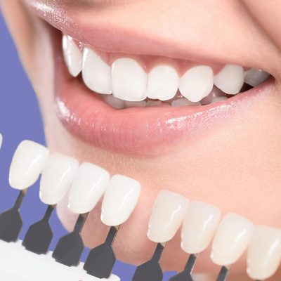 faceta-de-porcelana-cor-ideal-escolher copy